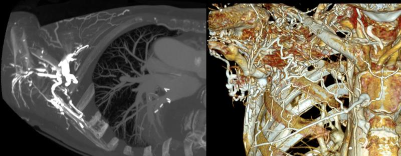 Contrast_wasted_due_to_venous_reflux