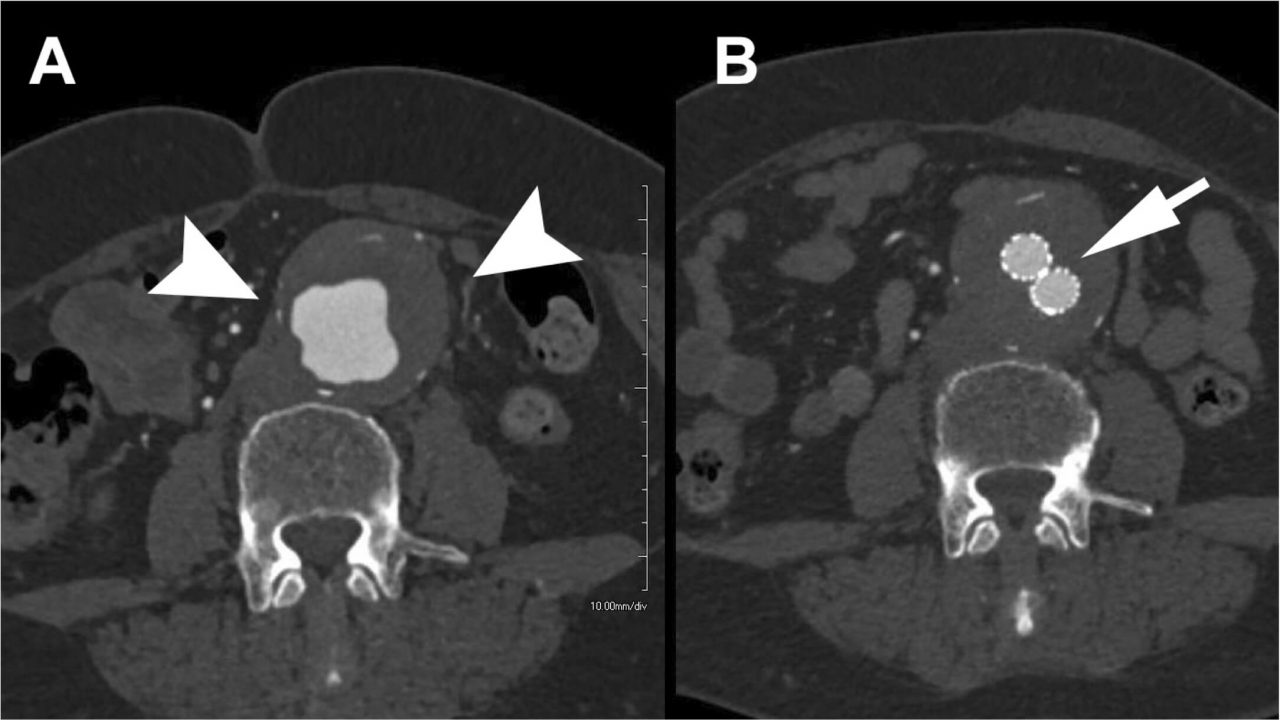 Endovascular Abdominal Aortic Aneurysm Repair (EVAR) - SmartInject ...