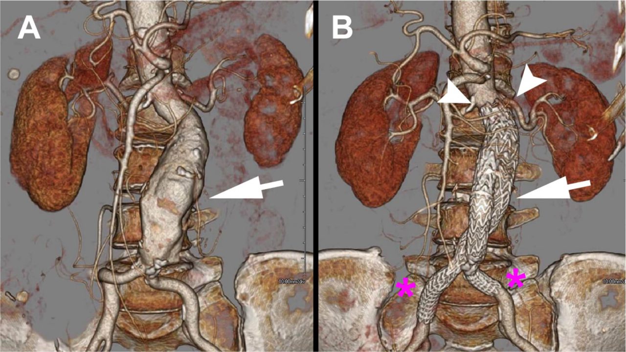 Endovascular Abdominal Aortic Aneurysm Repair (EVAR) - SmartInject ...