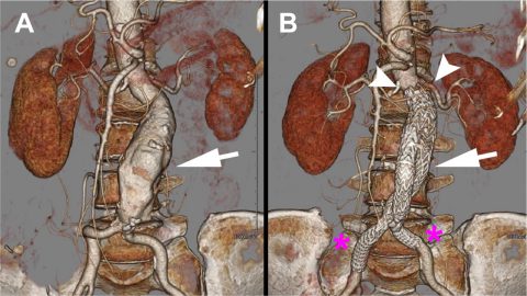 Endovascular Abdominal Aortic Aneurysm Repair (EVAR) - SmartInject ...