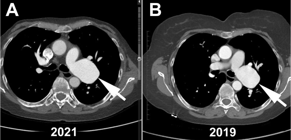 Pulmonary Artery Aneurysms - SmartInject Solutions