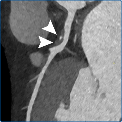 Coronary CTA with High-Risk Plaque (HRP)