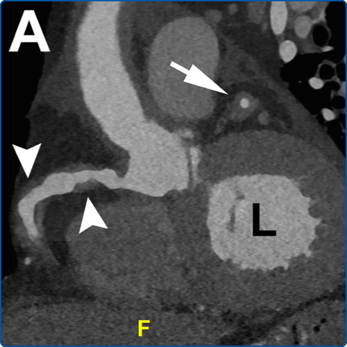 NEW: IgG4 Coronary Disease