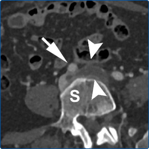 NEW: May-Thurner Syndrome