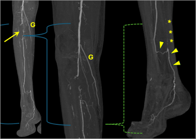 NEW: Bilateral, Symmetric Trifurcation Vessel Occlusive Disease with Additional Right Tibioperoneal Trunk Occlusion