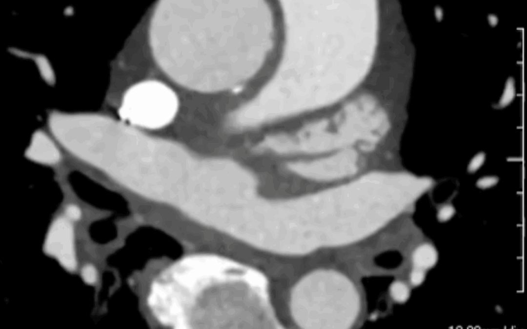 NEW: Prosthetic Valve Endoprosthesis (PVE)