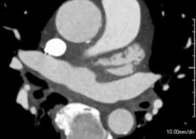 NEW: Prosthetic Valve Endoprosthesis (PVE)