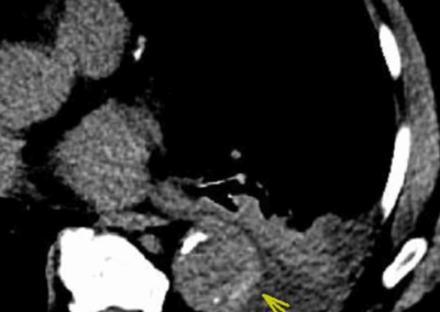 NEW: Symptomatic Intramural Hematoma (IMH) from Penetrating Atherosclerotic Ulcer (PAU) and Ulcer-Like Projections (ULP)