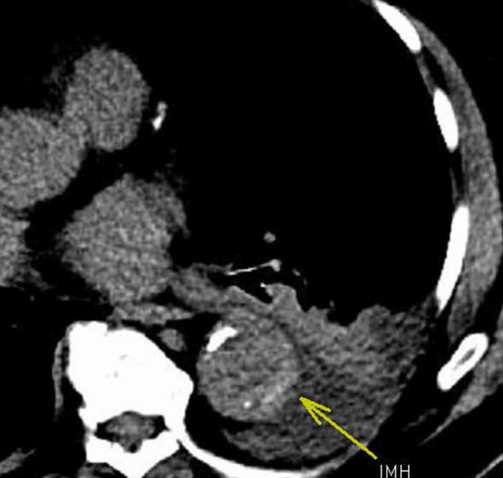 NEW: Symptomatic Intramural Hematoma (IMH) from Penetrating Atherosclerotic Ulcer (PAU) and Ulcer-Like Projections (ULP)
